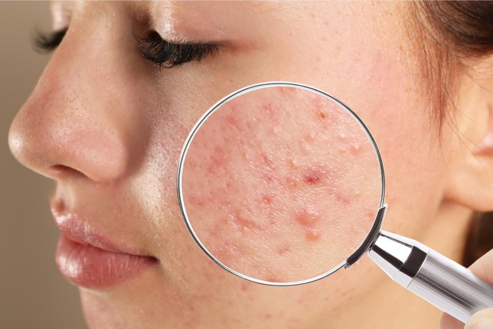 Seis dicas para acabar com a acne