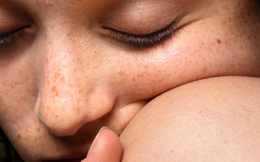 Melasma - As manchas após exposição solar incomodam? Saiba o que é e como tratar!