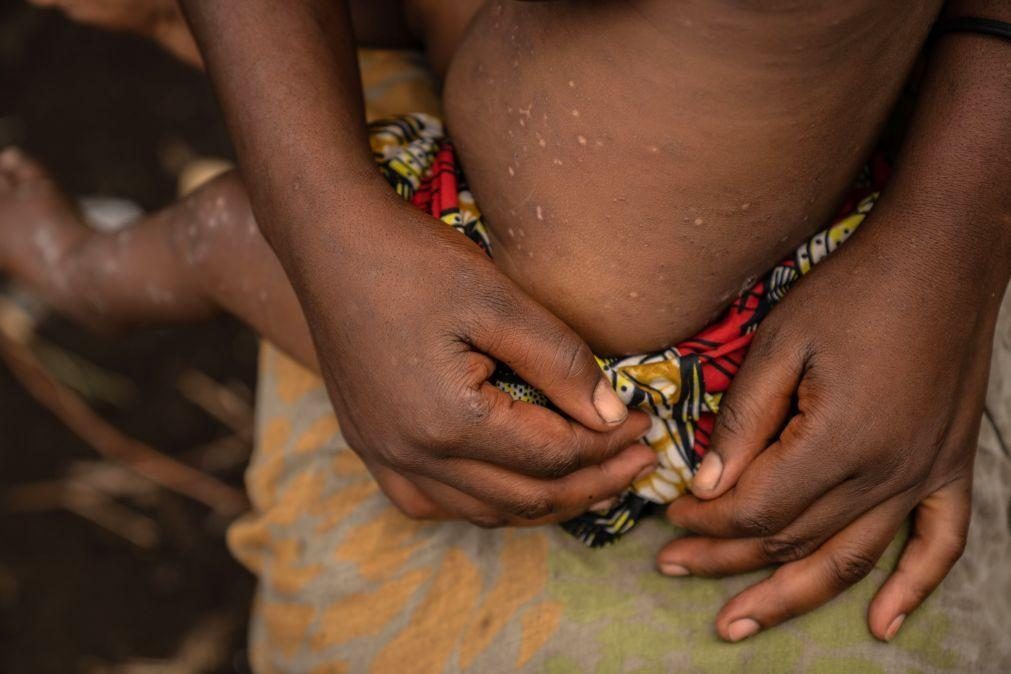 Mpox: Alemanha anuncia donativo de 100 mil vacinas para África