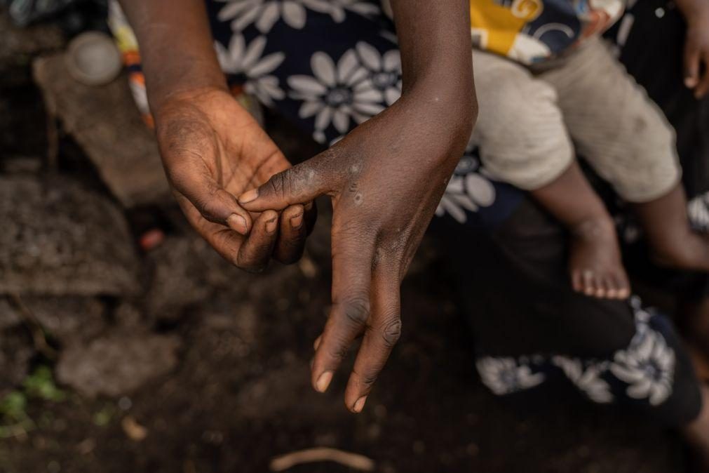 Mpox: Sem capacidade de testar Guiné-Bissau prepara plano de contingência