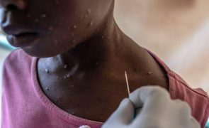 Mpox: Surto em Moçambique seria um desafio para um sistema de saúde já pressionado -- especialista