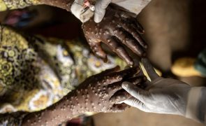 Nova variante da Mpox transmitida principalmente entre humanos